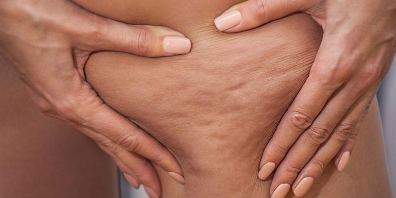 Cellulite Treatment With Light Therapy