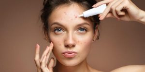 How to Get Rid of Acne Using Lighter Medications And Natural Remedies